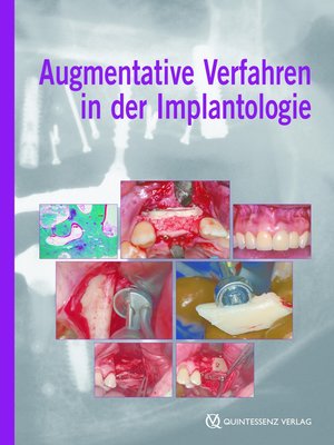 cover image of Augmentative Verfahren in der Implantologie